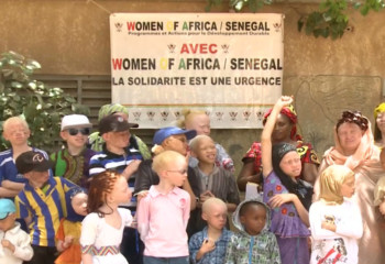 Violence soars against people with albinism