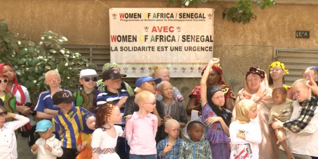 Violence soars against people with albinism