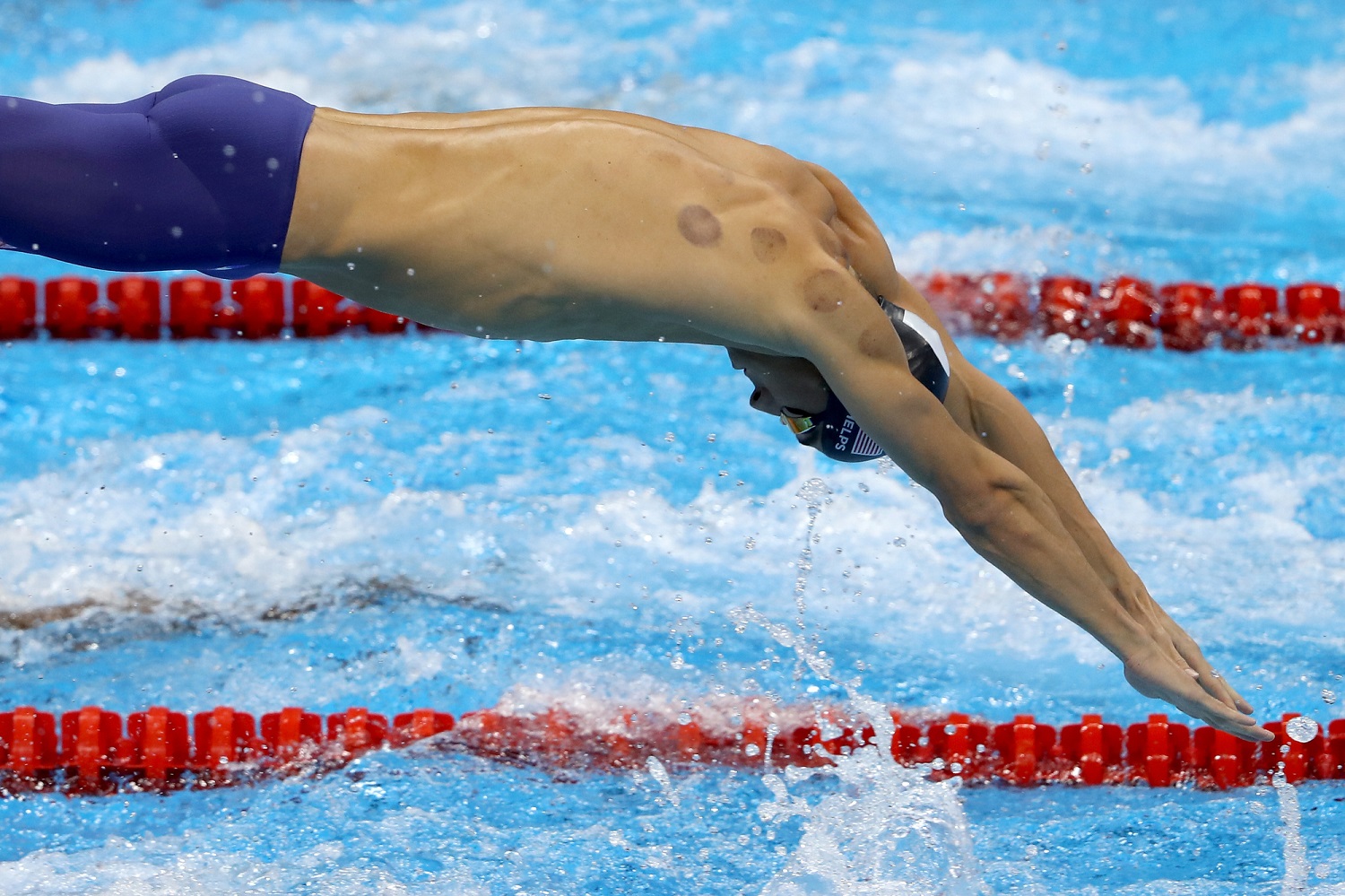 Why does Michael Phelps have purple spots on his back?