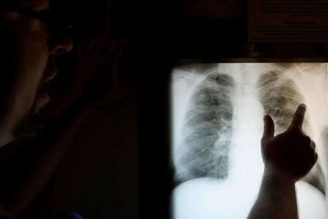 BLACK LUNG: Radiological technician Davis looks at the chest x-ray of retired coal miner Marcum in St. Charles