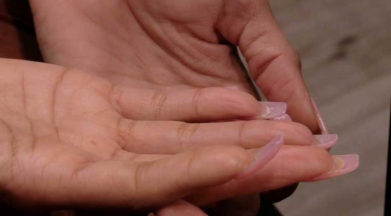 Cutting edge technology helps re-grow patient's injured finger