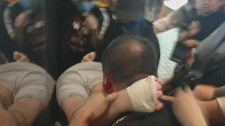 Local politician's ear bitten off at Hong Kong protest