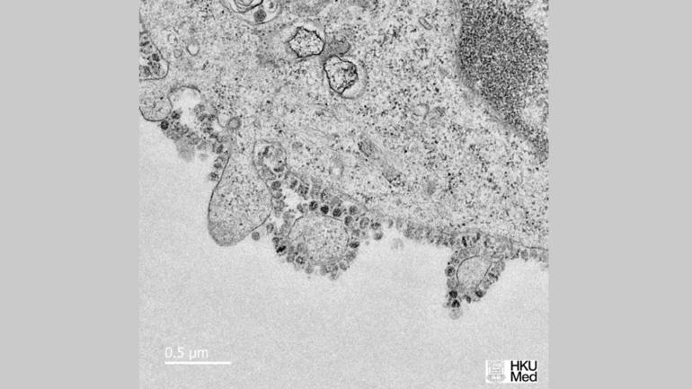 An electron microscopic image of the coronavirus grown in culture after 48 hours with a high magnification insert. Source: The University of Hong Kong