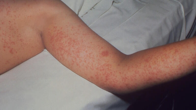 Measles outbreak spreads amid low vaccination rates in Texas